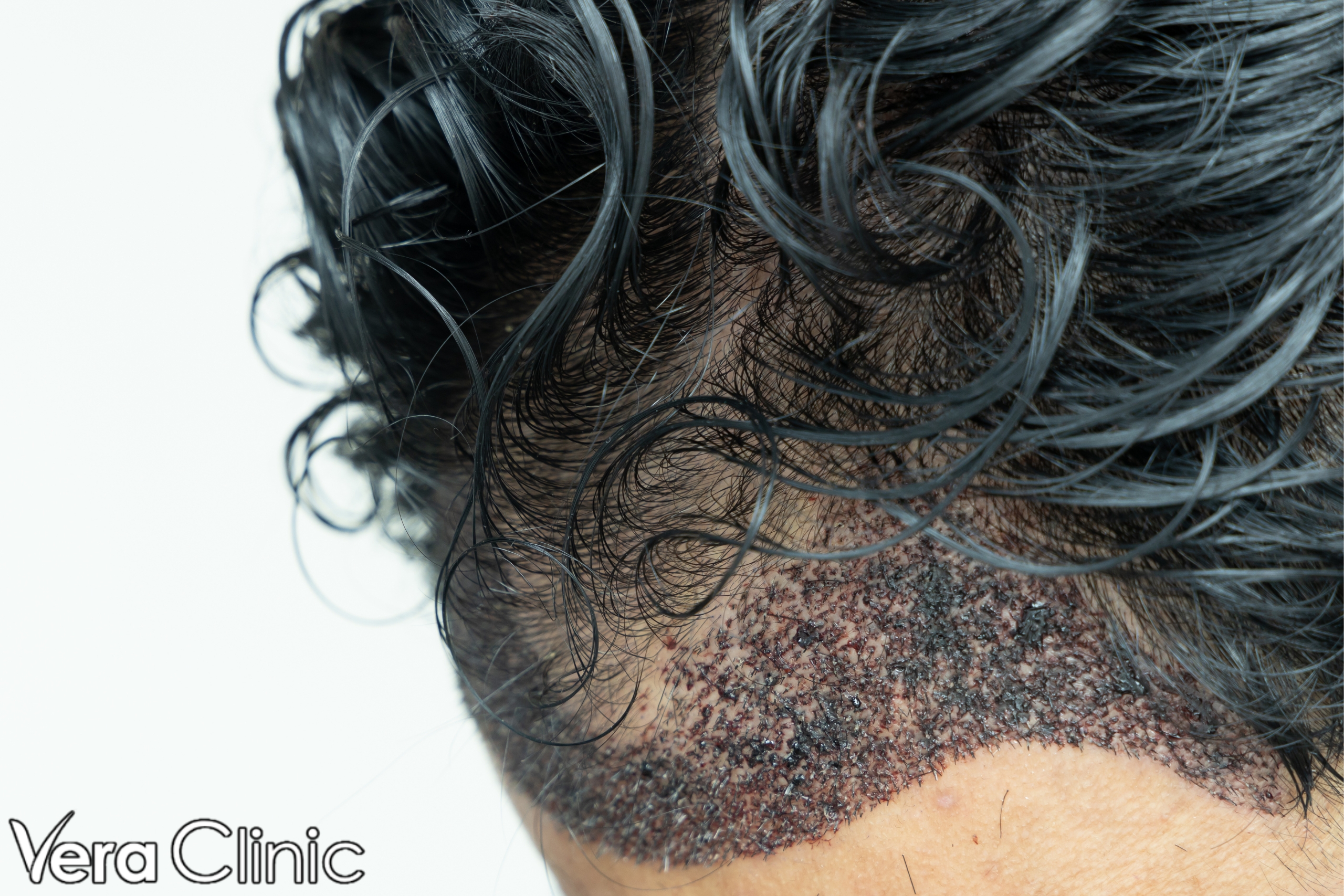 turkish hair transplant